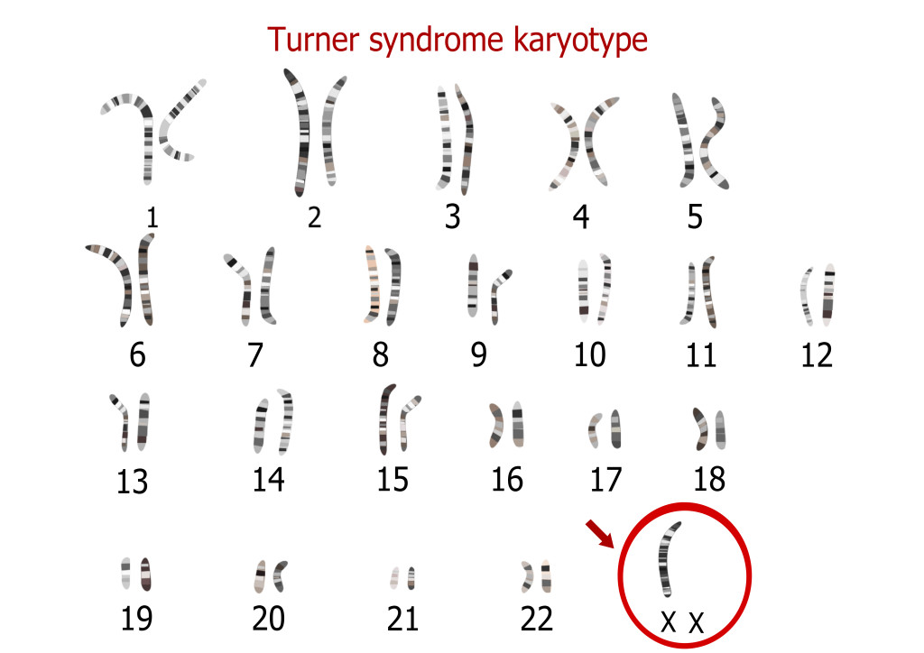 Er is een afwijking van 1 van de 46 X chromosomen bij het syndroom van turner