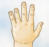 Syndroom-van-turner-hand-en-vingers Potentiële kenmerken: Opgezette handen en voeten (lymfoedeem), Broze, kleine en opgewipte nagels, Korte middenhandsbeentjes van pink en ringvinger