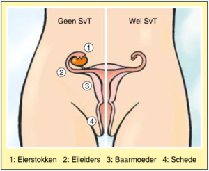 turner-en-puberteit-hoe-zit-dat-eierstokken-en-menstruatie Bij Turner vrouwen zijn de eierstokken verschrompelt