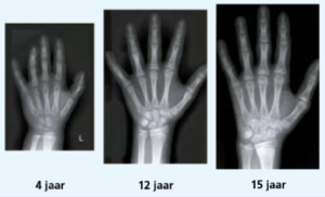 turner-en-puberteit-hoe-zit-dat-rontgenfotos-linkerhand Röntgenfoto’s van een linker meisjeshand op 3 verschillende leeftijden